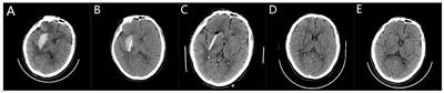 The efficacy of stereotactic minimally invasive thrombolysis at different catheter positions in the treatment of small- and medium-volume basal ganglia hemorrhage (SMITDCP I): a randomized, controlled, and blinded endpoint phase 1 trial